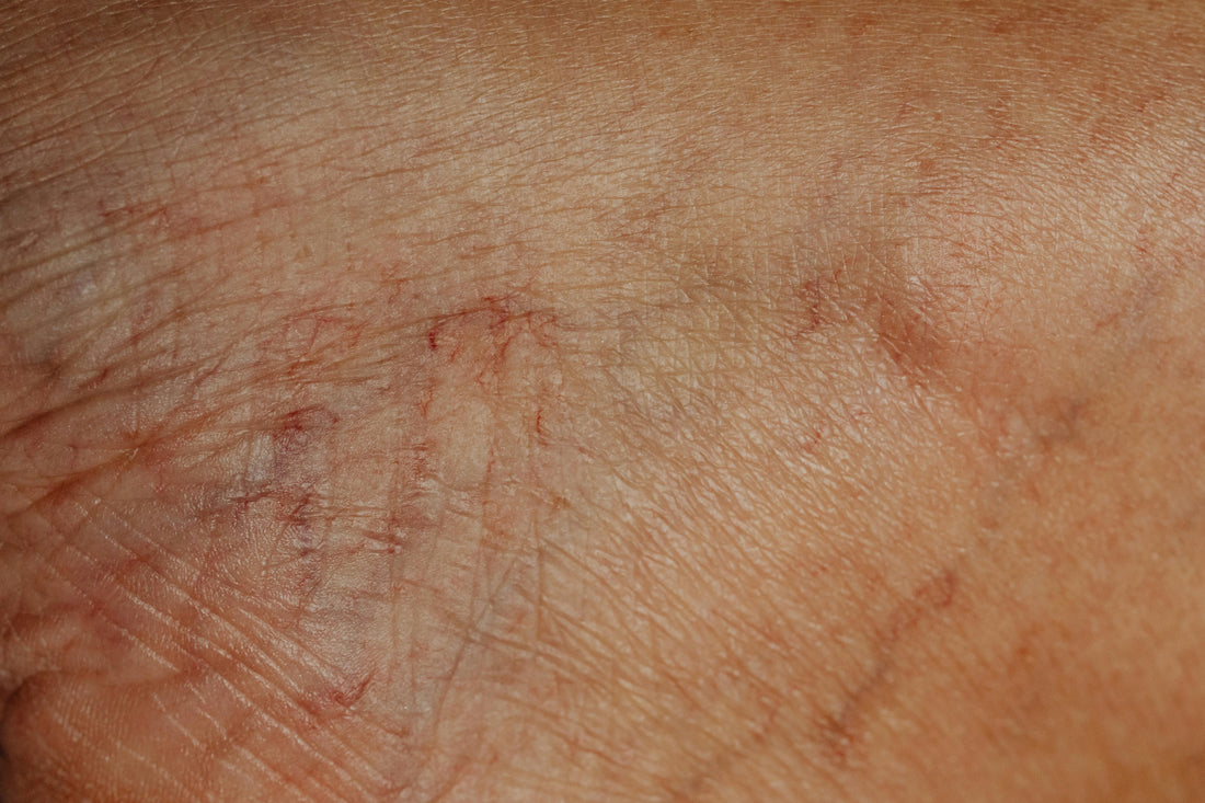 Why Are Women More Likely to Get Varicose Veins?